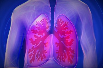 ECLS trial shows reduction in late-stage diagnoses of lung cancer