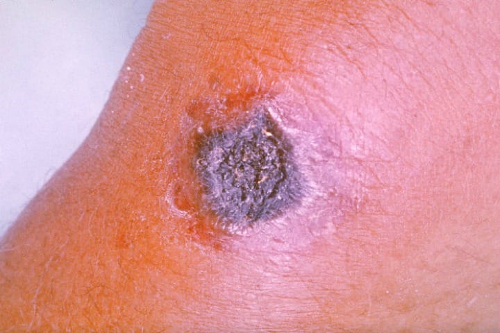 A lesion caused by cutaneous anthrax