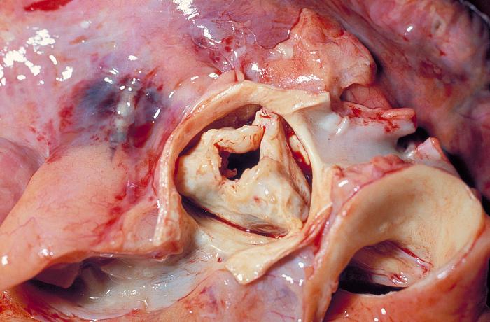 Gross pathology of rheumatic heart disease: aortic stenosis. Aorta has been removed to show thickened, fused aortic valve leaflets and opened coronary arteries from above.